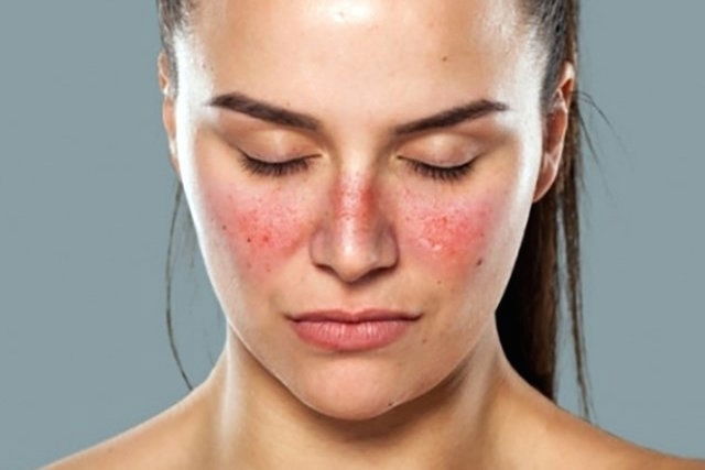 woman with red rash on cheeks