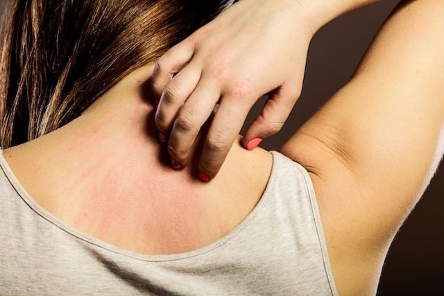 Illustrative image of the article Stress Hives: Symptoms, Diagnosis & Treatment