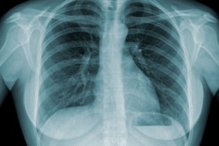 Imagen ilustrativa del artículo 6 síntomas de tuberculosis (pulmonar y extrapulmonar)