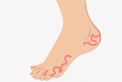 Image illustrative de l'article Démangeaisons des pieds: 9 causes (et que faire)