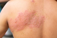 Image illustrative de l'article Zona (herpès zoster): symptômes, causes et traitement