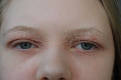 Imagem ilustrativa do artigo Eczema palpebral: o que é, sintomas, causas e tratamento