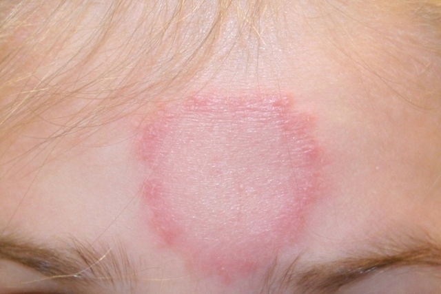 image montrant une peau atteinte de tinea corporis