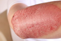 Image illustrative de l'article Psoriasis: symptômes, types et traitement