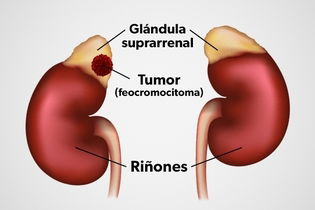 Imagen ilustrativa del artículo Feocromocitoma: qué es, síntomas y tratamiento 