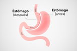 Imagen ilustrativa del artículo Manga gástrica: qué es, riesgos y cómo se realiza la cirugía