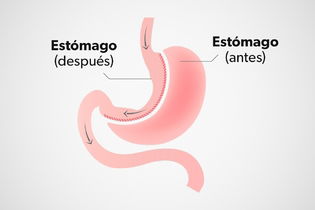 Imagen ilustrativa del artículo Manga gástrica: qué es, riesgos y cómo se realiza la cirugía