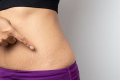 Illustrative image of the article How to Get Rid of Stretch Marks: 12 Treatments