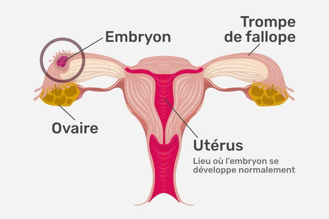 grossesse extra-utérine se développant dans la trompe de Fallope