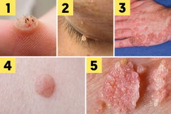 Image illustrative de l'article Verrues: symptômes, causes, transmission et traitement