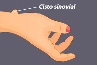 Imagem ilustrativa do artigo Cisto sinovial: o que é, sintomas, causas e tratamento