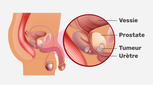 Image illustrative de l'article Opération de la prostate: indications, réalisation (et récupération)