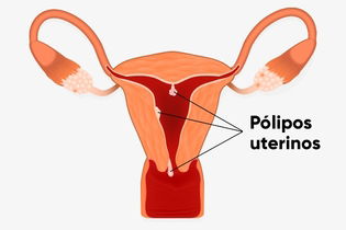 Imagen ilustrativa del artículo 8 Síntomas de pólipos endometriales y ¿son peligrosos?