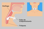 Imagen ilustrativa del artículo Traqueostomía: qué es, para qué sirve y cuidados