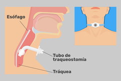 Imagen ilustrativa del artículo Traqueostomía: qué es, para qué sirve y cuidados