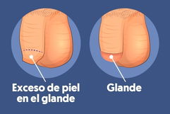 Imagen ilustrativa del artículo Qué es la fimosis, síntomas y tratamiento (en niños)