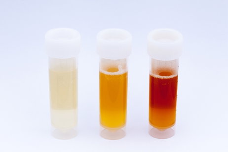 Image illustrative de l'article Hématies dans l'urine: 7 causes (et comment traiter)