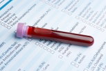 Illustrative image of the article Symptoms of High Cholesterol (Risk Factors & When to Get Tested)