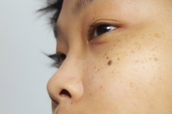 Illustrative image of the article Dermatosis: Types, Symptoms & Treatment