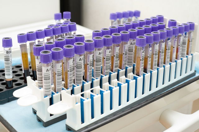 Image illustrative de l'article LDH (Lactate Déshydrogénase) : définition, taux élevé et faible