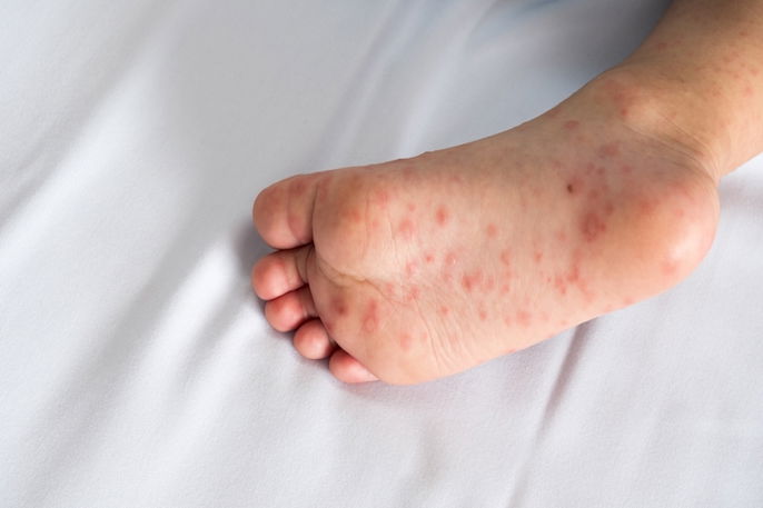 enfermedad de manos, pies y boca