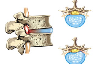 Imagen ilustrativa del artículo 4 Tratamientos para la hernia discal