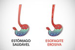 Imagem ilustrativa do artigo Esofagite erosiva: o que é, sintomas e classificação de Los Angeles 