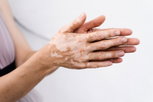 Imagen ilustrativa del artículo ¿Por qué da vitiligo?