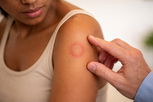 Illustrative image of the article Why do I have a red circle on my skin that is not itchy?