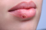 Illustrative image of the article I kissed someone with a cold sore. What should I do?