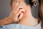 Illustrative image of the article How do I stop mosquito bites from itching?