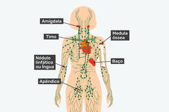 Imagem ilustrativa do artigo Câncer linfático: o que é, sintomas, causas e tratamento