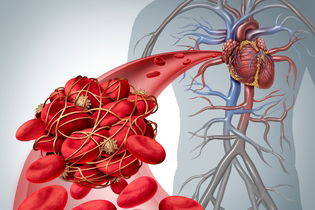 Imagen ilustrativa del artículo Coagulación intravascular diseminada: síntomas y tratamiento