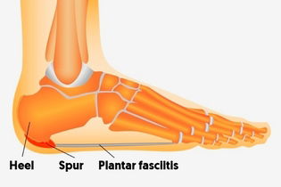 Illustrative image of the article Plantar Fasciitis: Symptoms, Causes, Treatment & Prevention