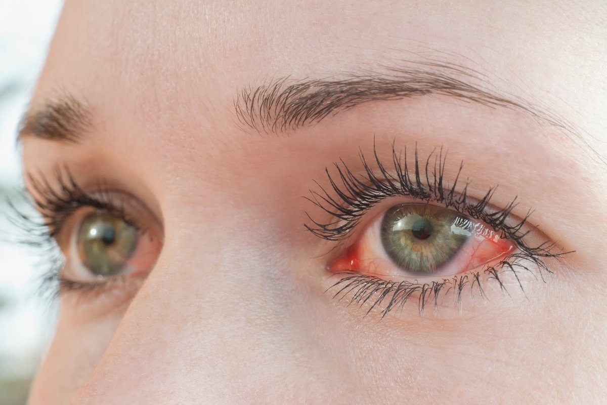 Yeux Rouges 13 Causes et Que Faire Tua Sa de