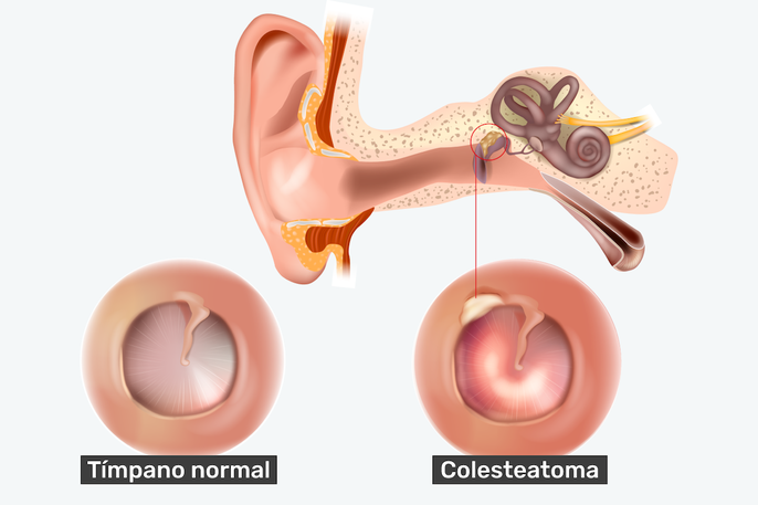 imagen colesteatoma