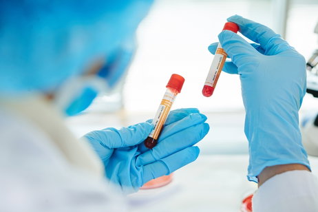 Image illustrative de l'article Hémoglobine glyquée: à quoi ça sert et valeurs de référence