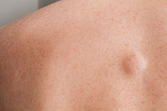 Imagen ilustrativa del artículo Qué puede causar una bola o bulto en la espalda (y qué hacer)