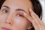 Imagen ilustrativa del artículo ¿Qué son las perrillas en los ojos?