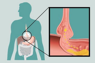 Imagen ilustrativa del artículo Qué es la hernia hiatal, síntomas y tratamiento