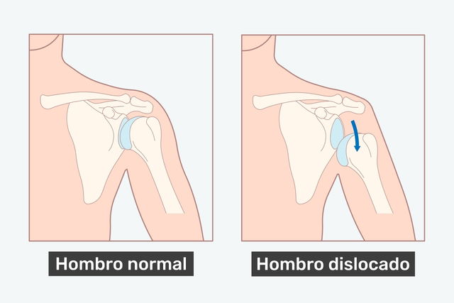 Imagen con un hombro normal y hombro dislocado