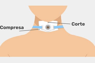 Imagen ilustrativa del artículo Traqueostomía: qué es, para qué sirve y cuidados