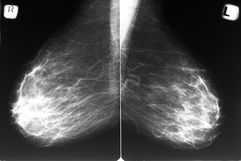 Illustrative image of the article Should I worry about dense breast tissue?