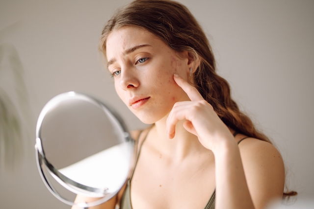 Mujer joven observando cicatrices de granos en su rostro frente al espejo