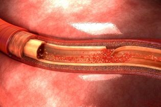 Imagem ilustrativa do artigo O que é dissecção da aorta, principais sintomas e tratamento