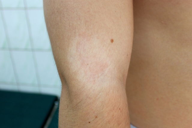 Illustrative image of the article White Spots On Skin: 9 Causes (with Pictures)