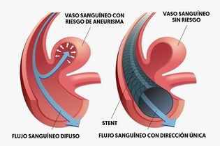 Imagen ilustrativa del artículo Aneurisma cerebral: qué es, síntomas y causas 