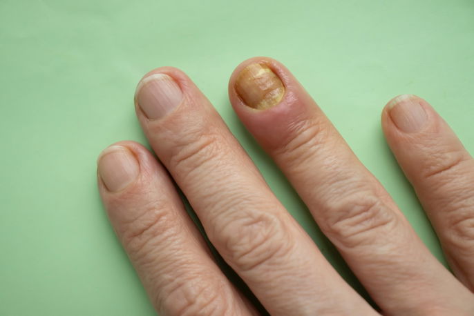 Ring finger demonstrating signs of paronychia