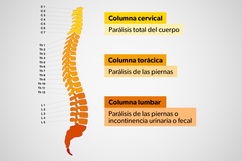 Imagen ilustrativa del artículo Fractura de columna: síntomas, tratamiento y recuperación 