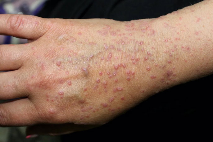 lichen planus